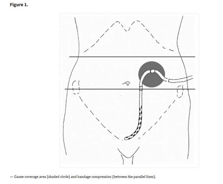 Peritoneal Bleed Management of pericannular bleeding after peritoneal dialysis catheter ...