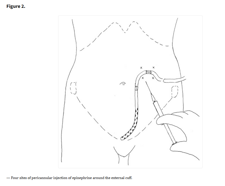 Peritoneal Bleed Management of pericannular bleeding after peritoneal dialysis catheter ...